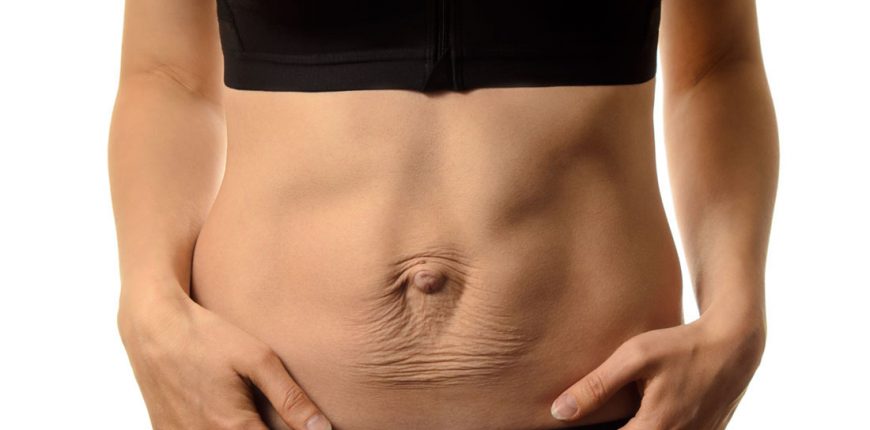 Diastasis of Rectus Abdominis Muscle (DRAM)/ Abdominal Separation﻿