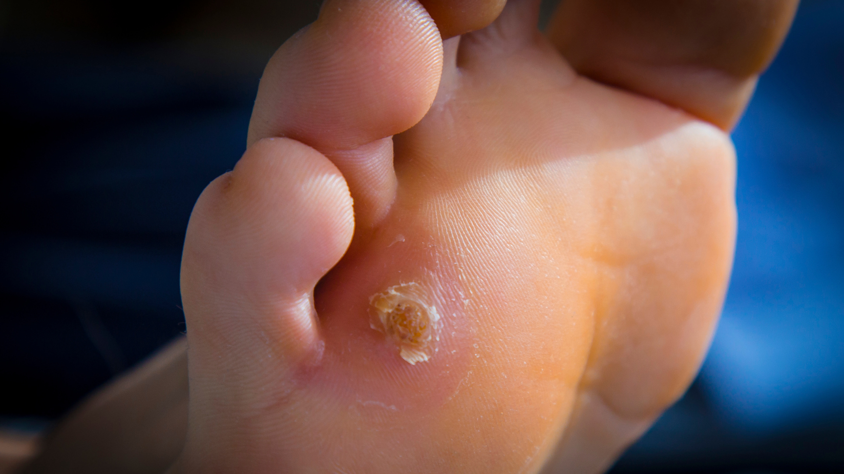 Foot Pain in Children? Understanding Corns, Calluses & Long-Term Solutions