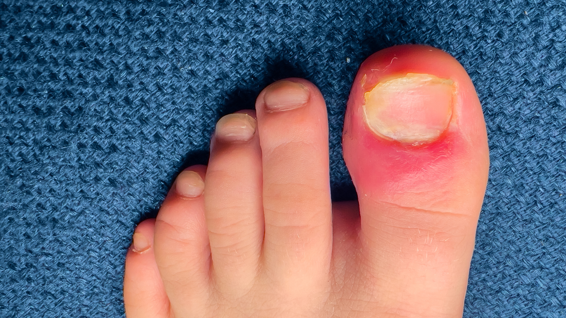 Ingrown Toenails in Children: What Parents Should and Should Not Do