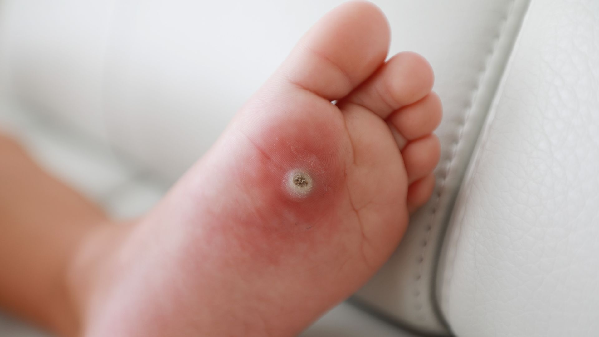 Plantar Warts in Kids: Causes, Treatment, and When to See a Podiatrist