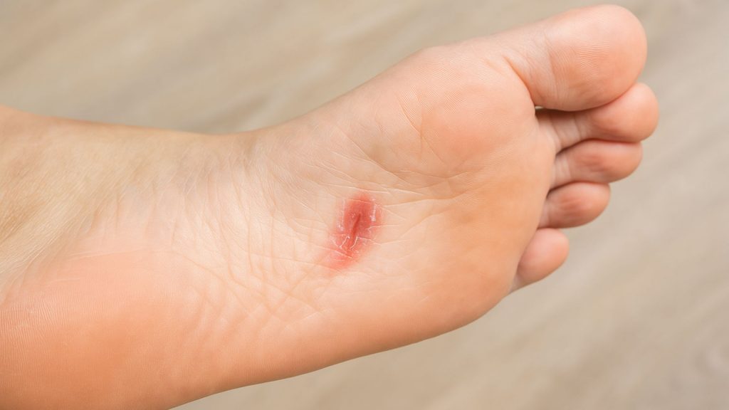 Close-up of small skin abrasion on foot that allows HPV entry causing plantar warts