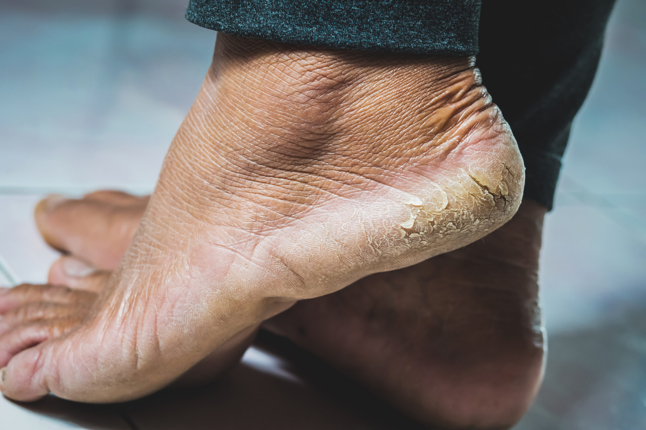 What are Foot Fissures?