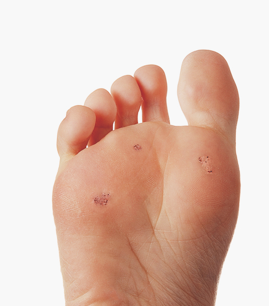 Plantar Warts