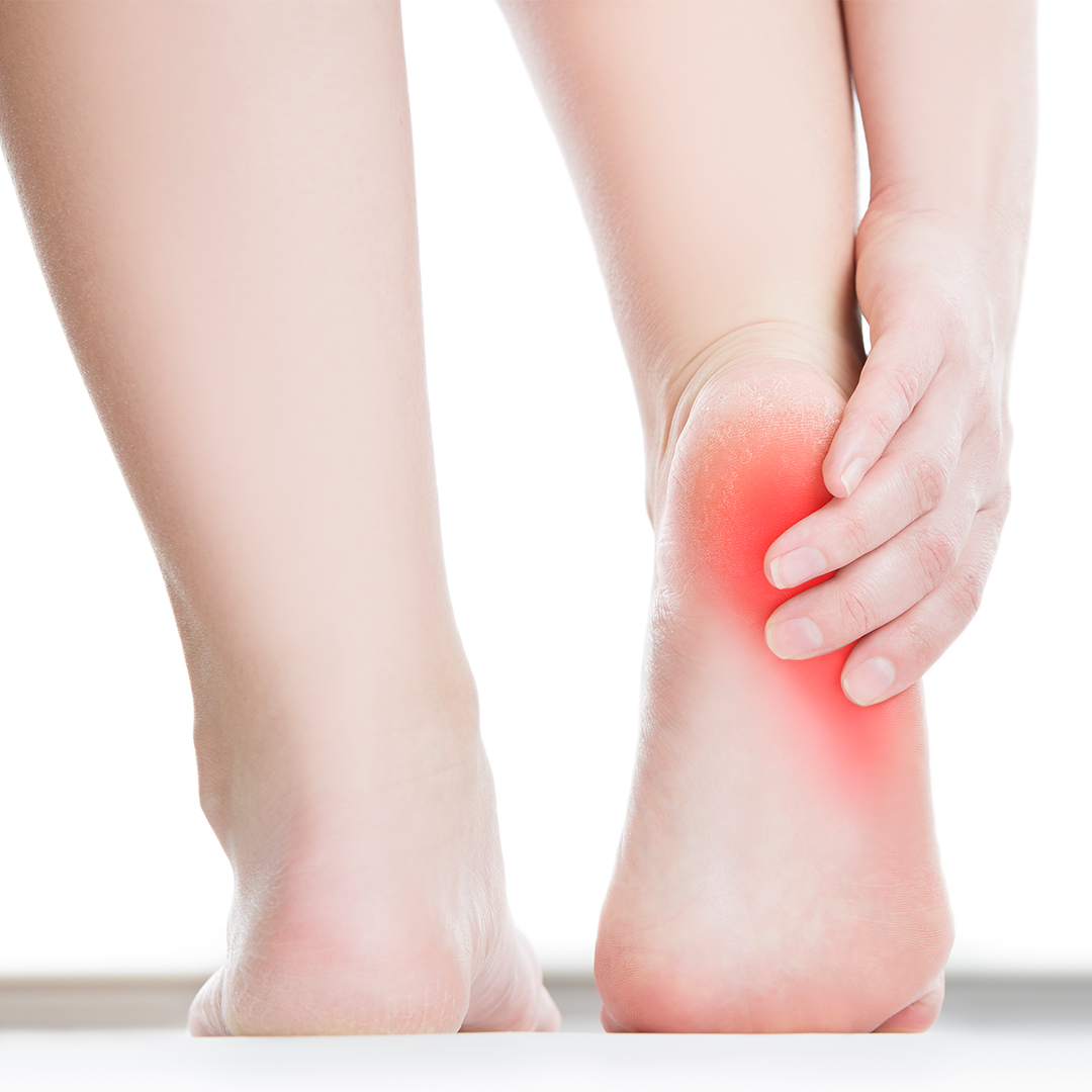 Cracked Heels