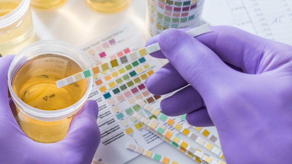 Close-up of a urine test strip being compared against a colour chart for bladder health and incontinence diagnosis.