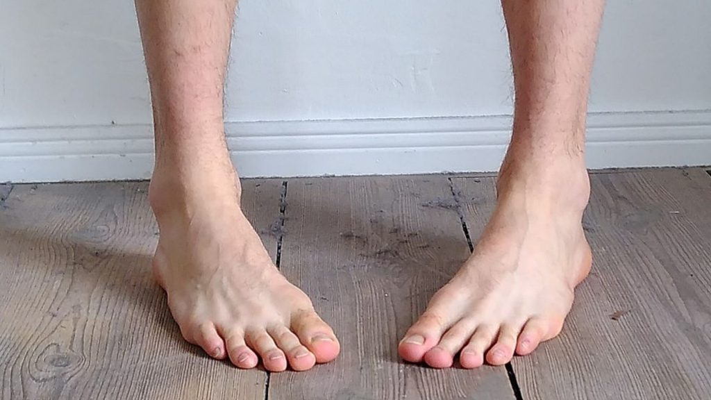 Adult standing with feet turned inward, showing untreated intoeing from childhood.