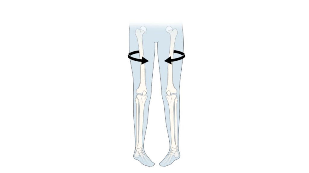 Medical diagram of thigh bone rotating inward, causing knees and feet to point in.