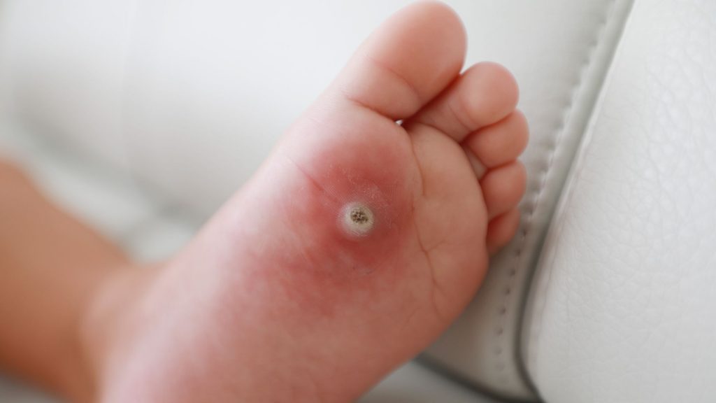 Close-up view of plantar wart on child’s heel showing rough skin and dark centre