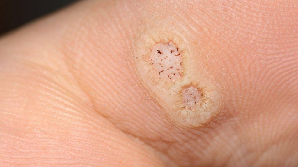 Close-up of multiple plantar warts on foot caused by HPV infection in children