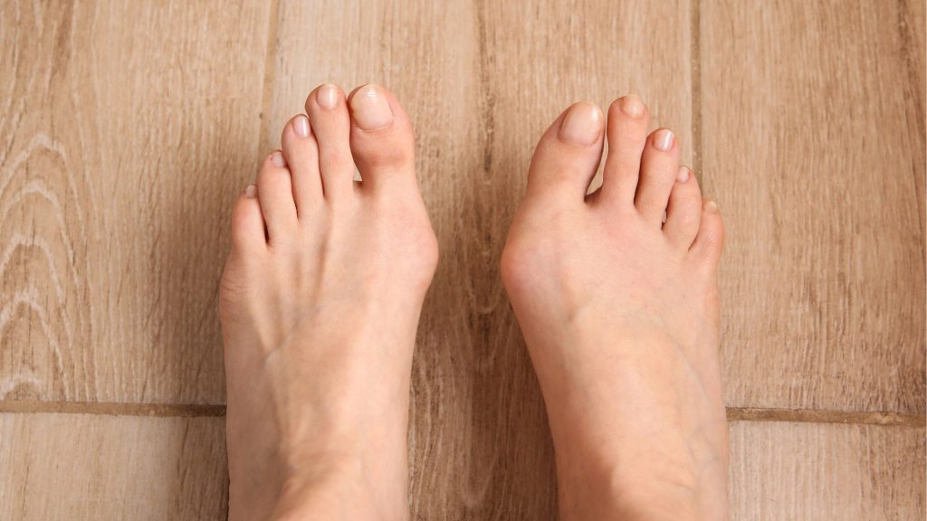 Close-up of female feet showing bunions and toe misalignment on a wooden floor.