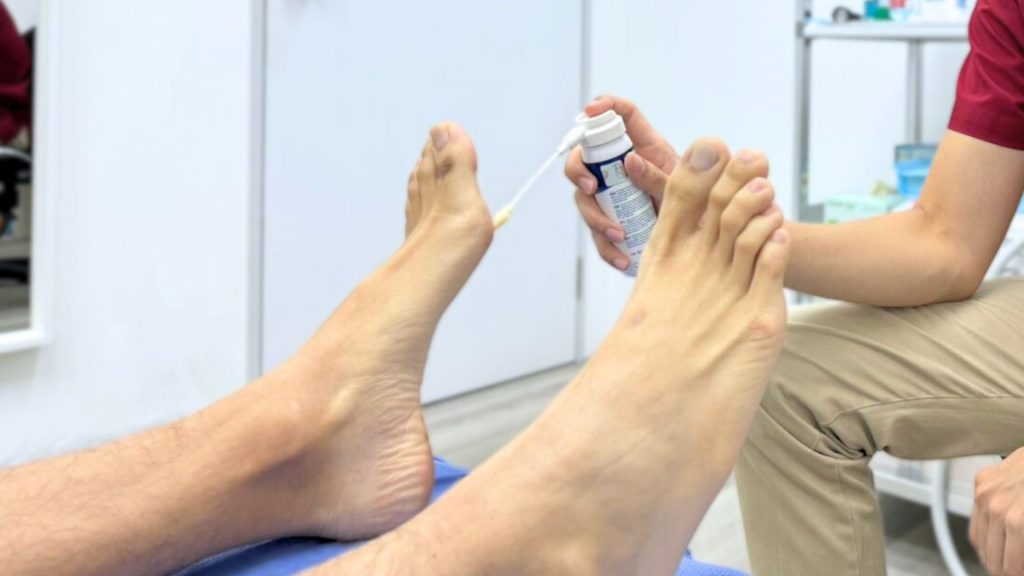 Podiatrist applying cryotherapy spray on patient’s foot to treat plantar wart safely and effectively in Singapore clinic