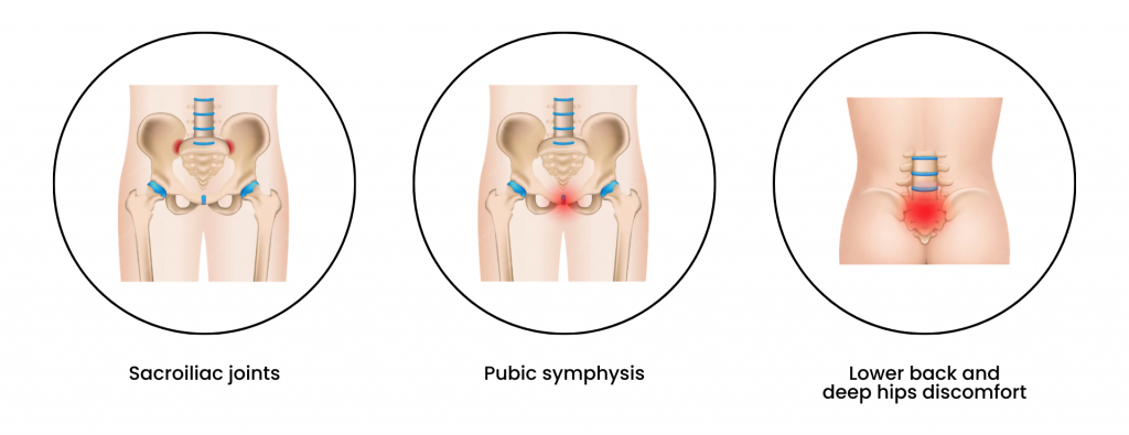 Illustration showing three common pelvic girdle pain areas: the sacroiliac joints at the back of the pelvis, the pubic symphysis at the front of the pelvis, and lower back and deep hip pain highlighted in red.