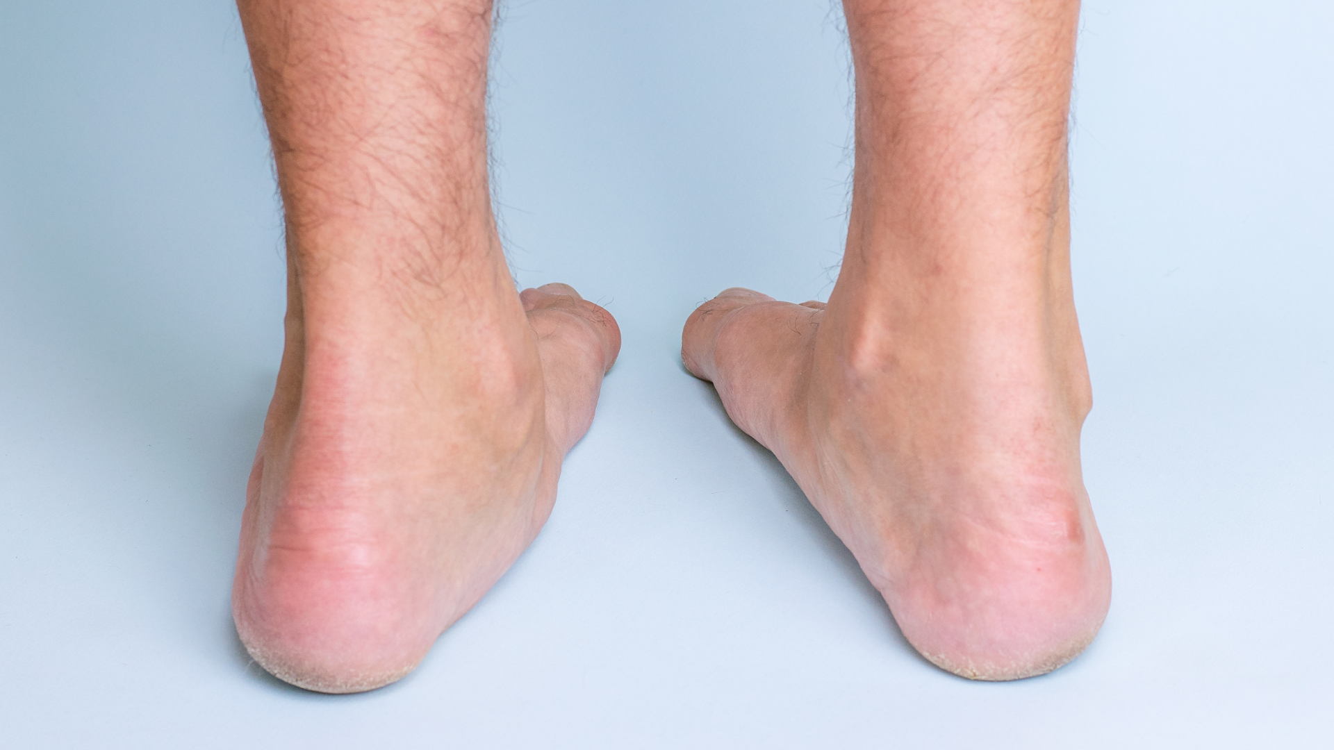 4. Overpronation (Flat Feet)