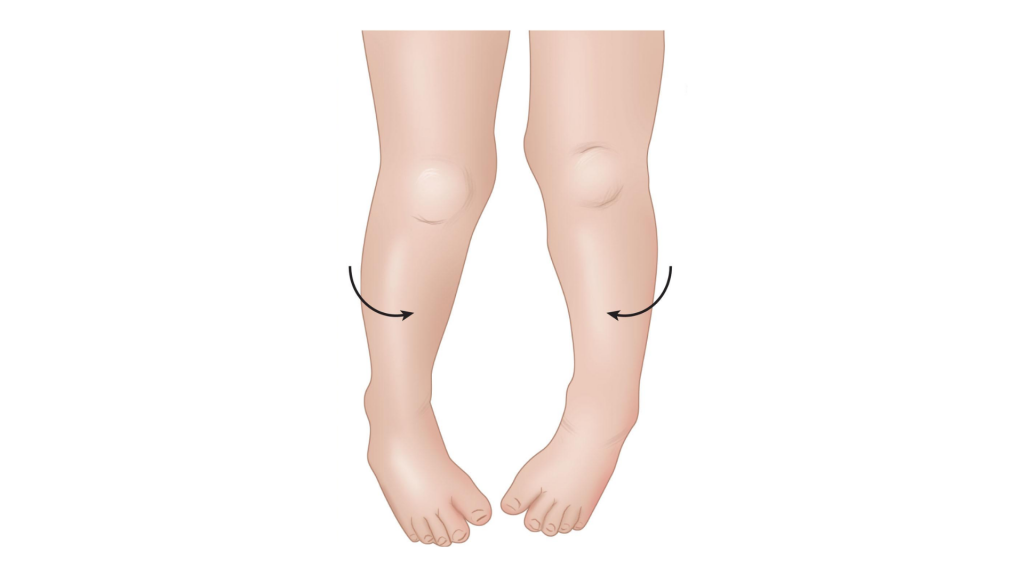Diagram of shinbone twisting inward, a common cause of intoeing in children.
